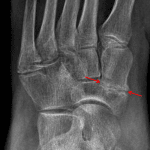 Different patient with fibrocartilagenous coalition between the navicular and medial cuneiform, evidenced by joint space narrowing and articular surface irregularity on either side.