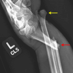 Galeazzi fracture dislocation with a distal radial fracture (red arrow) and dislocation of the distal ulna (yellow arrow) which protrudes through the skin.