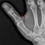 Red arrow: gamekeeper's thumb injury with a small avulsion fracture at the site of ulnar collateral ligament (UCL) attachment.
