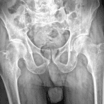 Red arrow: nondisplaced fracture of the right greater trochanter.