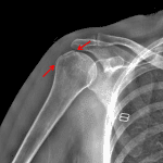 Red arrows: minimally displaced greater tuberosity fracture (one-part).