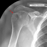 Grade II acromioclavicular (AC) separation with normal coracoclavicular distance of 11 mm. Red arrow: nondisplaced greater tuberosity fracture.