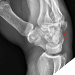 Red arrow: distal hamate fracture with dorsal displacement and associated dorsal dislocation of the fifth metacarpal base.
