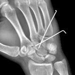 Followup radiograph in this patient after percutaneous pinning.