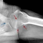 Postreduction axillary view: large Hill-Sachs impaction fracture (red arrows) and Bankart lesion (blue arrow).