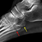 Red arrow: fifth metatarsal base fracture. Yellow arrow: plantar cuboid fracture.