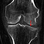 Red arrow: minimally depressed lateral tibial plateau fracture on the subsequent CT.
