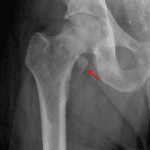 Red arrow: distracted lesser trochanter avulsion fracture.