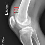 Lipohemarthrosis. Red arrows indicate the fat-fluid level.