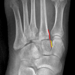 Lisfranc injury: offset of the medial margins of the second metatarsal base (red line) and middle cuneiform (yellow line).