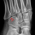 Red arrows: nondisplaced cuboid fracture best seen on the oblique view.