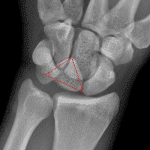 Lunate dislocation: triangular configuration of the lunate on the frontal view (red dotted lines) with the lunate abnormally overlapping the capitate and hamate, indicating capitolunate dislocation.