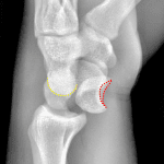 Lunate dislocation: volar dislocation and tilt of the lunate (articular surface outline in red). Maintained radiocapitellar alignment with proximal migration of the capitate (articular surface outlined in yellow).