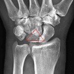 Lunate dislocation: triangular configuration of the lunate on the AP view with overlap of the lunate with the capitate and scaphoid indicating abnormal position and rotation of the lunate.