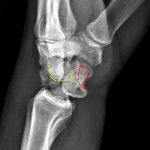 Somewhat oblique lateral view shows volar subluxation of the lunate (articular surface outlined in red) and capitate (articular surface outlined in yellow) maintaining its alignment with the radius.