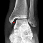 Medial clear space widening (red line compared to the normal blue line).