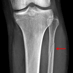 Subsequent tibia/fibula radiographs show a Maisonneuve fracture of the proximal fibula (red arrow).