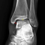Widening of the medial clear space (red line) relative to other intervals in the ankle mortise (e.g. yellow line).