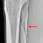 Subsequent lower leg radiograph shows a spiral fracture of the proximal fibula (red arrow).