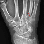Red arrow: minimally impacted fracture along the radial aspect of the fifth metacarpal base.