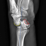 Midcarpal dislocation: volar subluxation and tilt of the lunate (articular surface outlined in red) and dorsal subluxation of the capitate (articular surface outlined in yellow). Blue line: normal axis of alignment.