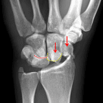 Midcarpal dislocation with offset of the capitate (yellow line) and lunate (red line) articular surfaces. Scaphoid fracture fragments (red arrows) give the appearance of 4 bones on the proximal carpal row.