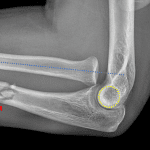 Monteggia fracture/dislocation: proximal ulnar fracture (red arrow) with volar radial head dislocation (blue dotted line along the long axis of the radius does not instersect the yellow circle delineating the capitellum).