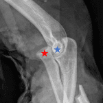 Monteggia fracture/dislocation with anterior dislocation of the radial head (red star) relative to the capitellum (blue star).