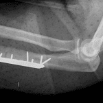 Post-ORIF radiograph in this patient.