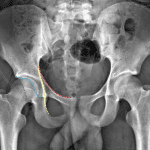 Important acetabular lines: Red - iliopectineal line, Yellow - ilioischial line, Blue - anterior wall, Purple - posterior wall.