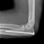 Olecranon fracture: postsurgical radiograph in this patient.