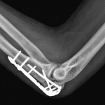 Postoperative radiograph in this patient.