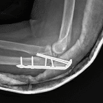 Postoperative radiograph in this patient.