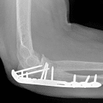Postoperative radiograph in this patient.