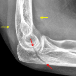 Red arrows: nondisplaced intraarticular olecranon fracture. Yellow arrows: uplifting of the anterior and posterior fat pad due to a joint effusion.