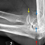 Red arrow: olecranon fracture. Yellow arrow: radial head fracture. Blue arrows: fracture at the base of the capitellum with superior rotation of the fracture fragment.