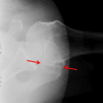 Red arrows: os acromiale.