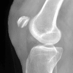 Postoperative radiograph in this patient after partial patellectomy.