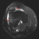 Sequela of lateral patellar dislocation. MRI in this patient shows kissing contusions in the medial patella and lateral femoral condyle (red arrows).