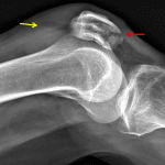 Red arrow: mildly comminuted fracture of the inferior pole of the patella. Yellow arrow: fat-fluid level indicative of lipohemarthrosis.