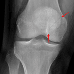 Red arrows: nondisplaced patellar fracture.