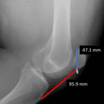Patella alta: tibial tuberosity to patella distance (red line) divided by patellar height (blue line) is greater than 1.2.