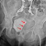 Red arrows: pelvic hematoma exerting mass effect on the left aspect of the bladder.