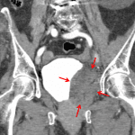 Red arrows: large left pelvic hematoma confirmed on the subsequent CT.