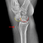 Perilunate dislocation with dorsal dislocation of the capitate (yellow dotted line) relative to the lunate (red dotted line). Red arrow: shear fracture fragments from Lister's tubercle or from the dorsal lunate.
