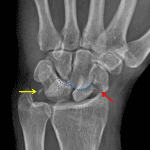 Offset of the lunate (purple dotted line) and capitate (blue dotted line). Red arrow: displaced scaphoid waist fracture. Yellow arrow: remote ulnar styloid tip fracture.