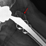 Red arrow: periprosthetic fracture of the greater trochanter.