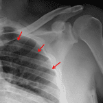 Red arrows: small left pneumothorax.