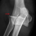Red arrow: tiny ossific fragment along the lateral aspect of the joint which may represent a chip or avulsion fracture.