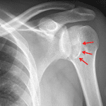 Red arrows: reverse Hill-Sachs fracture of the inferomedial humeral head resulting in a trough sign on frontal views.